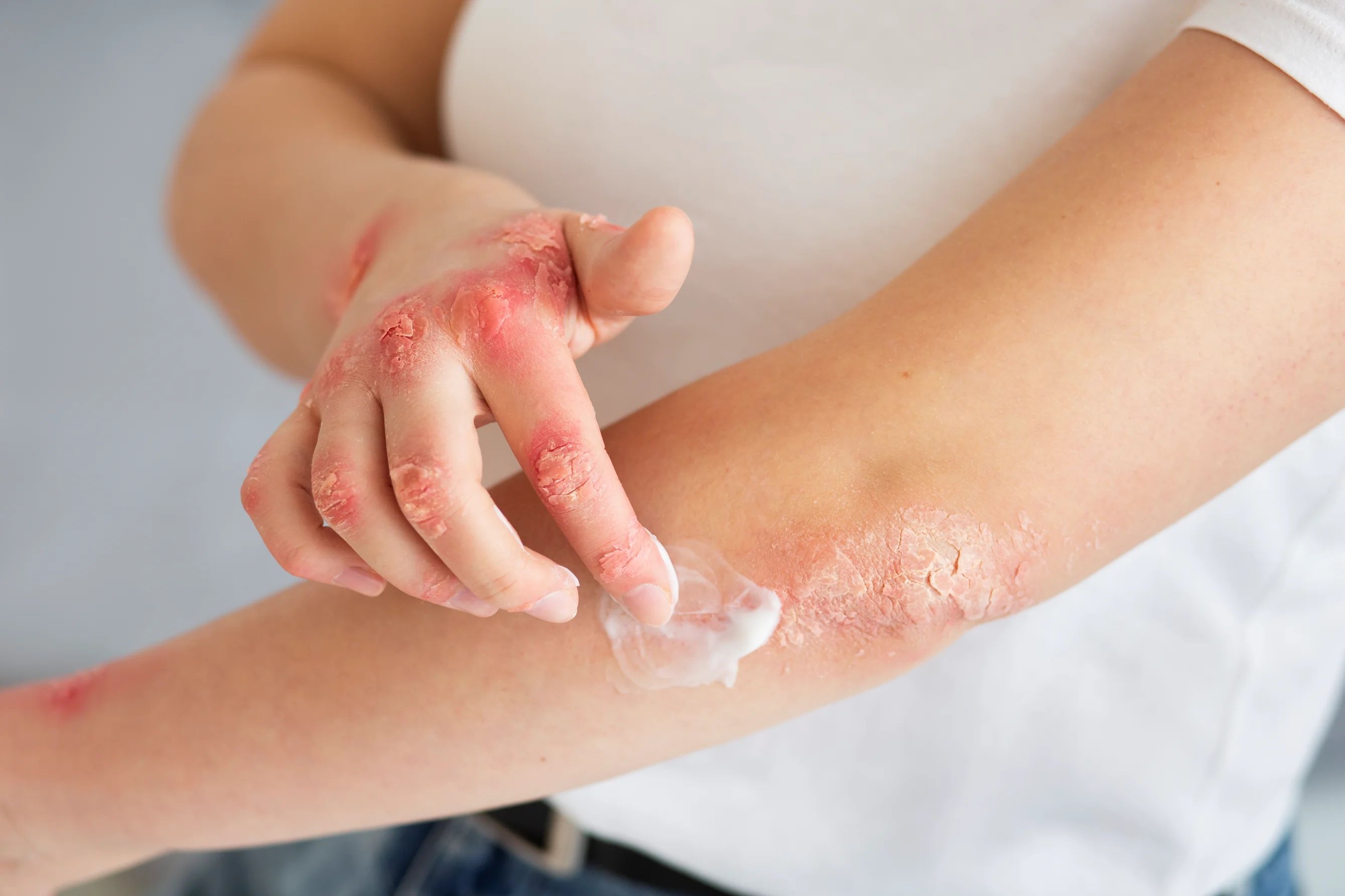 Piel con dermatitis